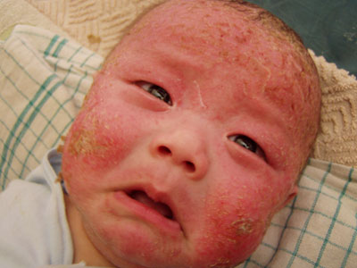 幼児性湿疹