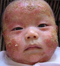 幼児性湿疹で顔がぐちゃぐちゃ